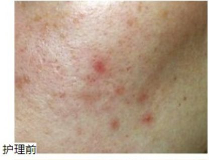 PG平台“在新加坡烂脸好不了爆痘长斑被人嫌！抱着试试看的心态我做了这件事”(图2)