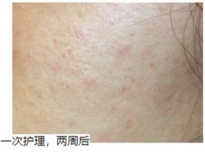 PG平台“在新加坡烂脸好不了爆痘长斑被人嫌！抱着试试看的心态我做了这件事”(图3)