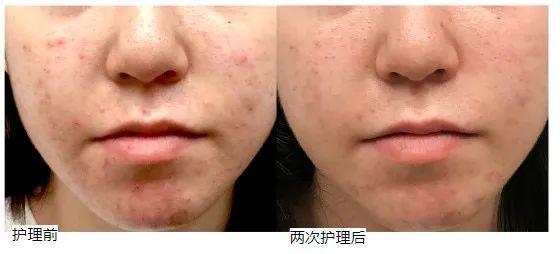 PG平台“在新加坡烂脸好不了爆痘长斑被人嫌！抱着试试看的心态我做了这件事”(图4)