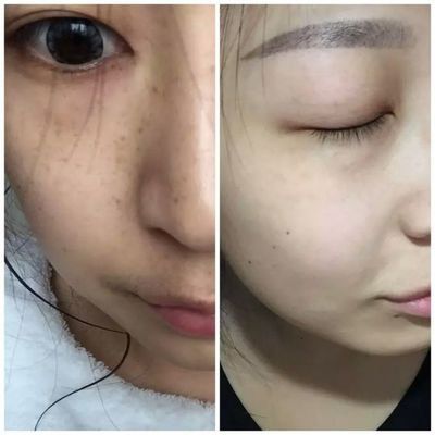 PG电子平台国家唯一认证的祛斑产品2024最新祛斑精品十佳榜(图4)