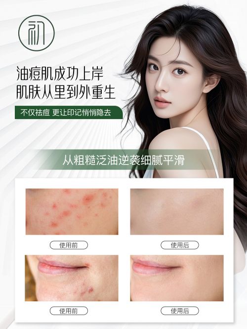 什么产品祛痘最好用？十大宝藏品牌推荐适合中学生祛痘的护肤品(图4)