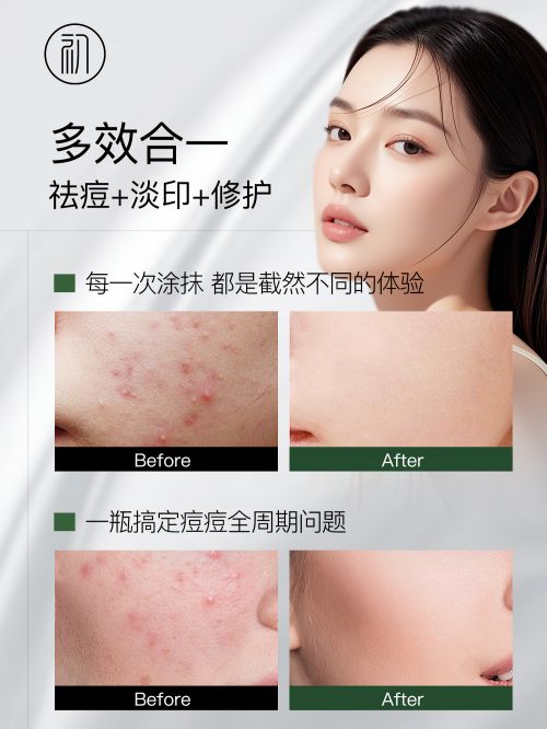 什么产品祛痘效果最好？适合学生祛痘的护肤品品牌温和不伤肤(图4)