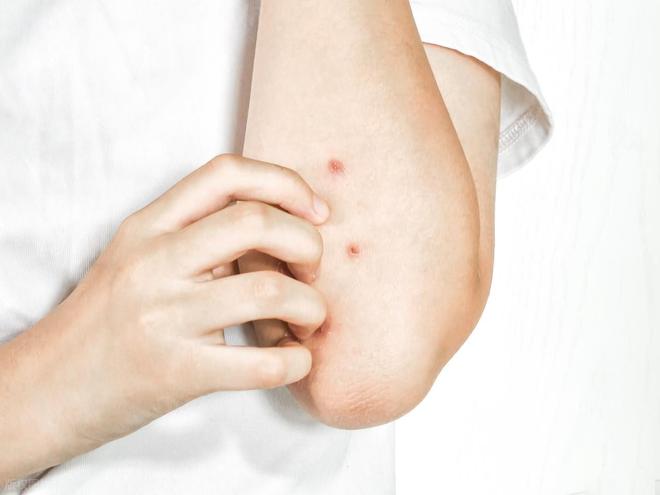 人不会无缘无故患湿疹！医生调查发现：得湿疹的人离不开这5点(图2)