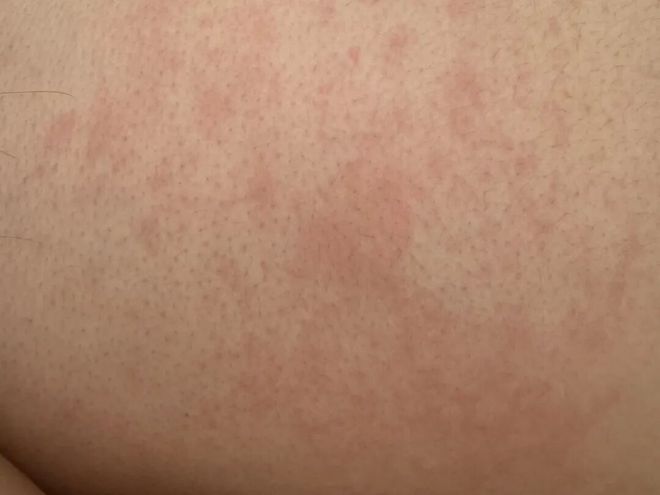 PG平台你真的分得清皮肤是干、是敏还是痒吗？(图1)