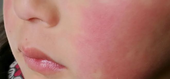 PG平台你真的分得清皮肤是干、是敏还是痒吗？(图10)